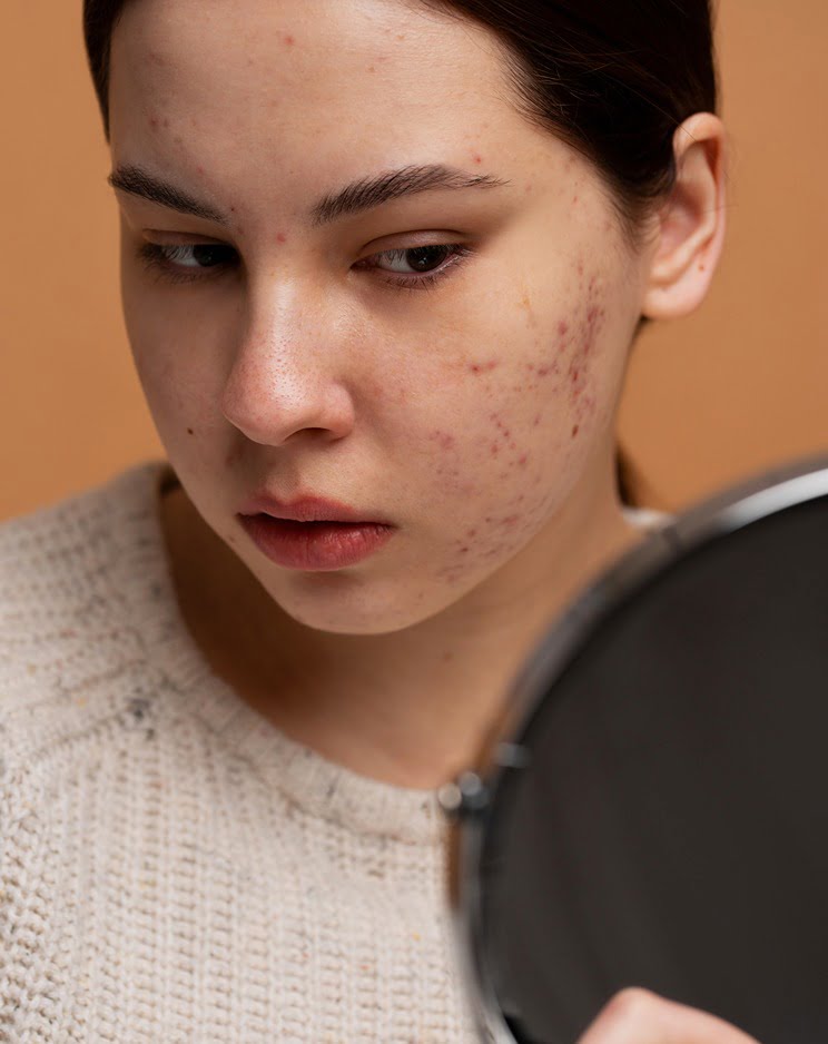 acne removal in Pune