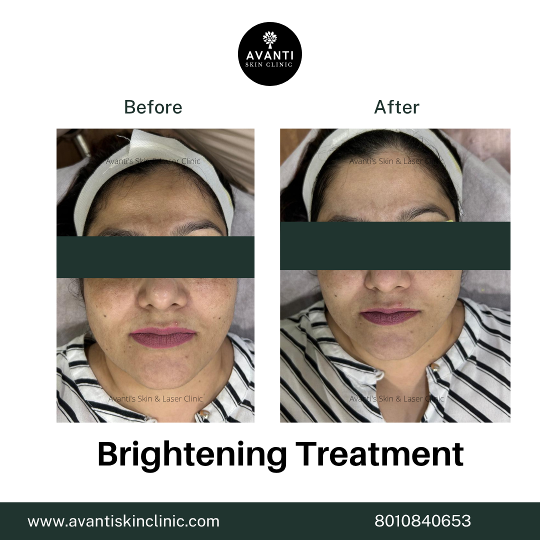 Acne Treatment (10)