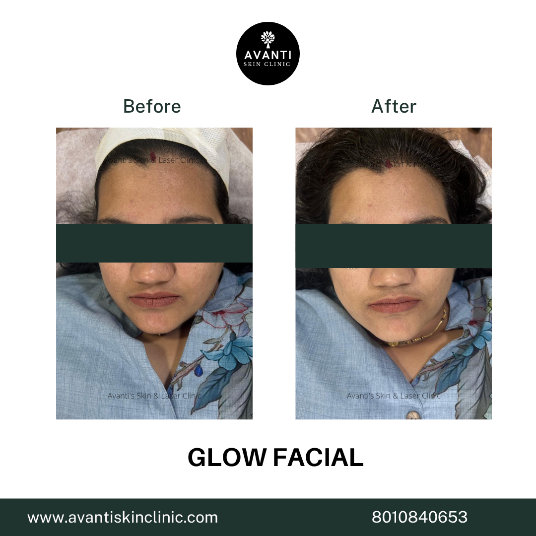 Acne Treatment (16)