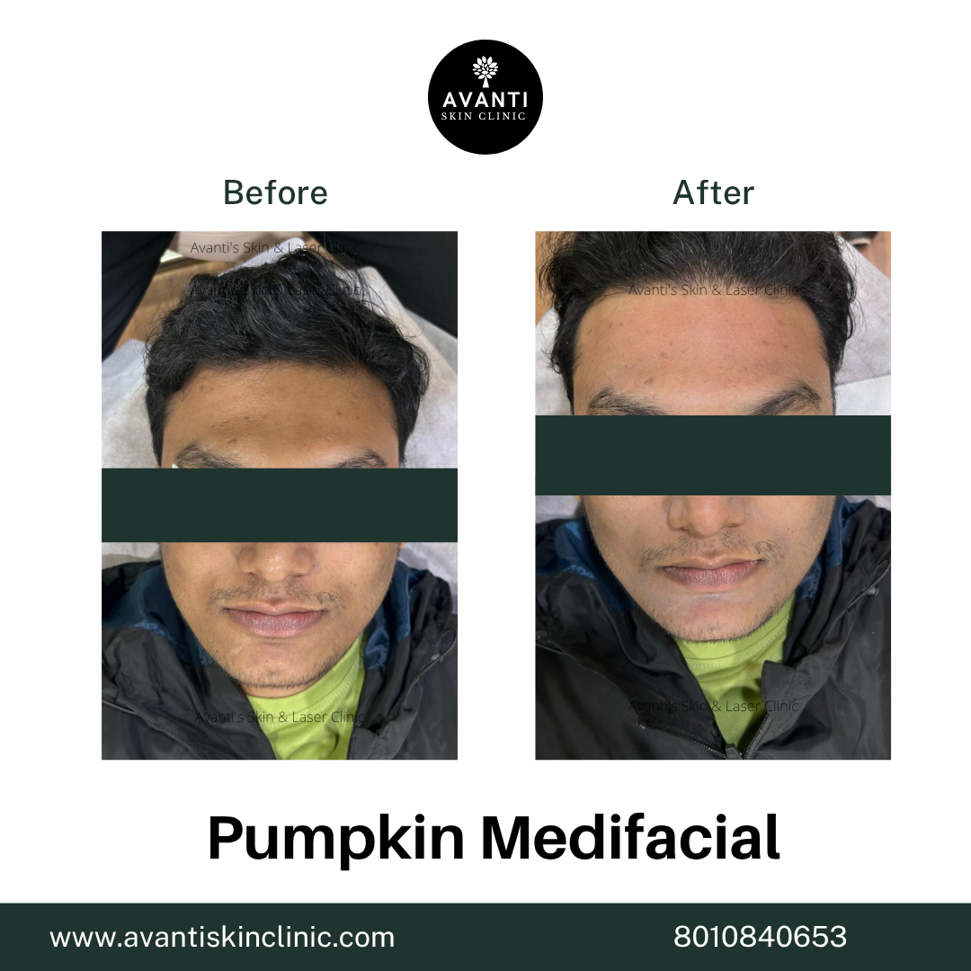 Acne Treatment (17)