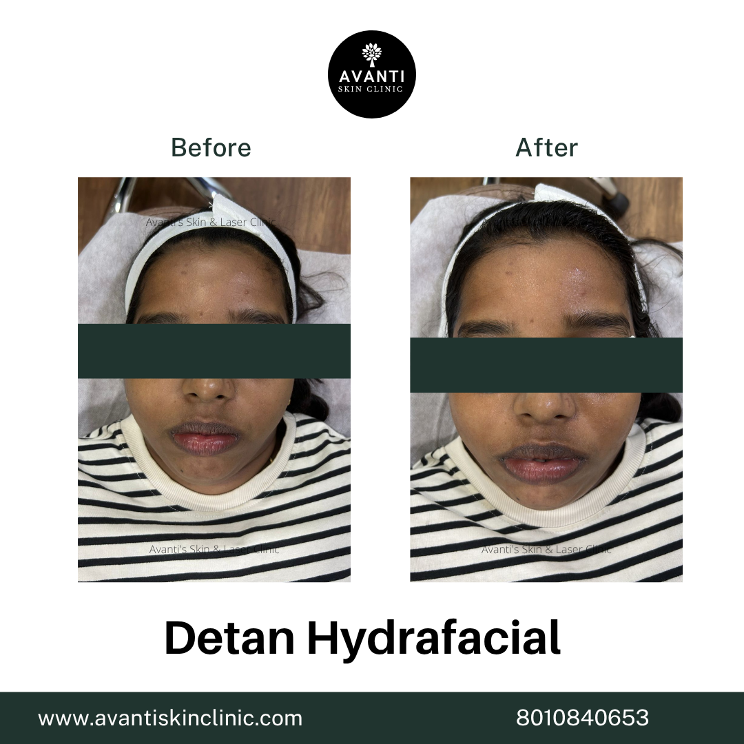 Acne Treatment (18)