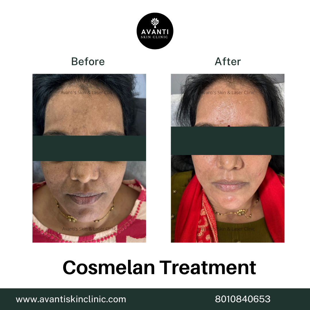 Acne Treatment (2)