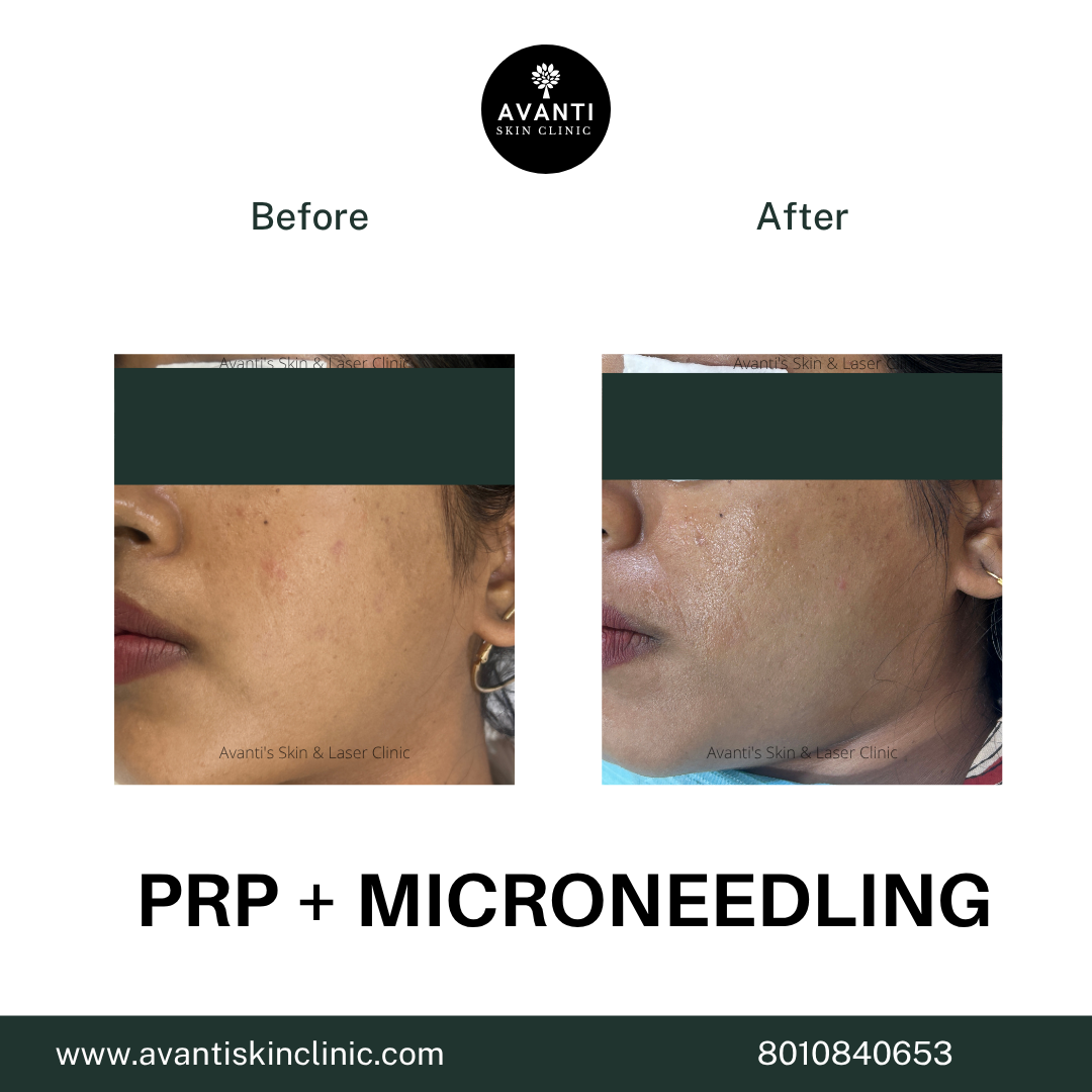 Acne Treatment (25)