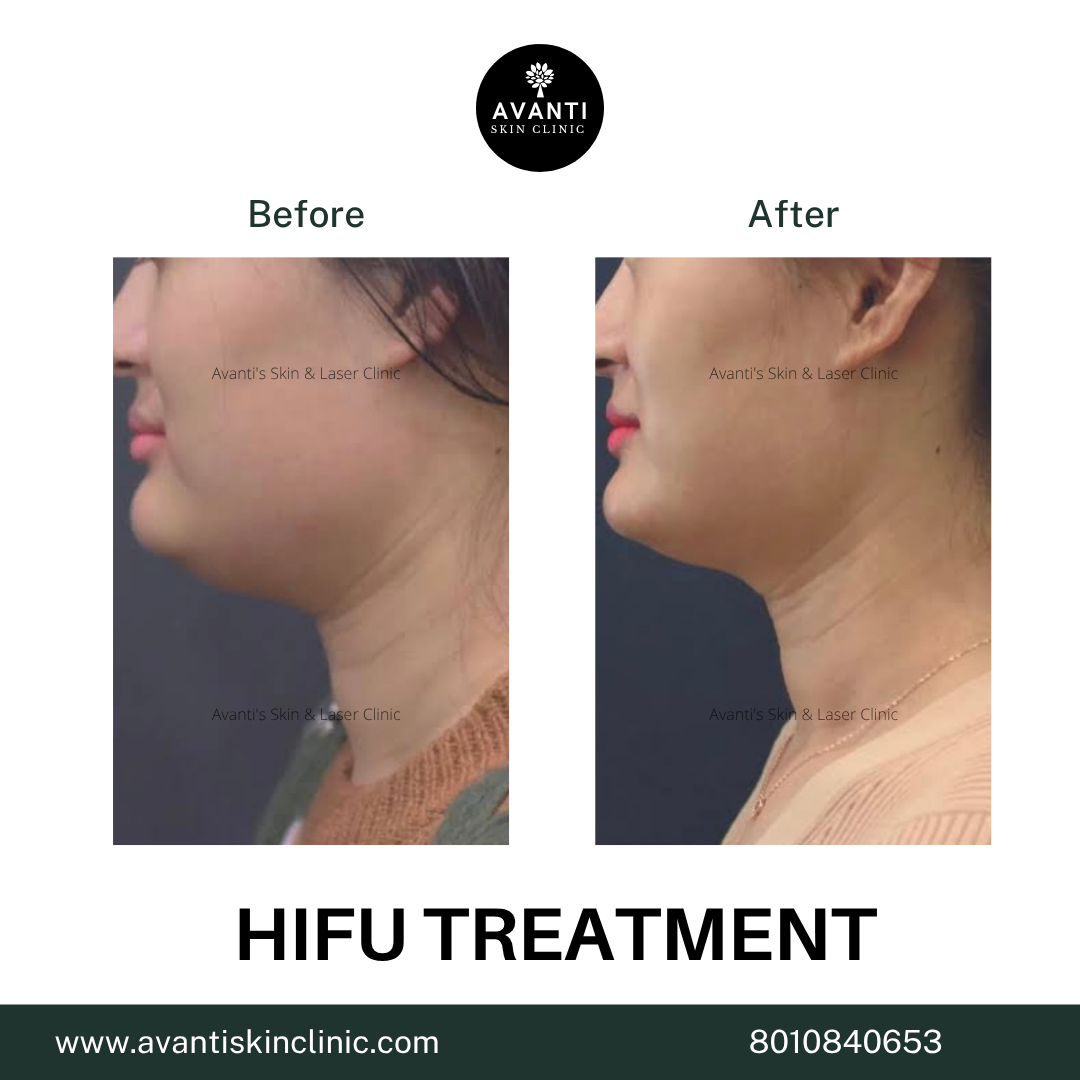 Acne Treatment (28)