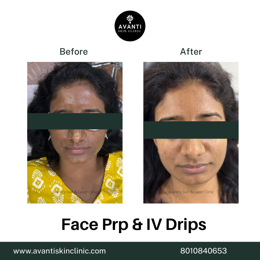 Acne Treatment (3)