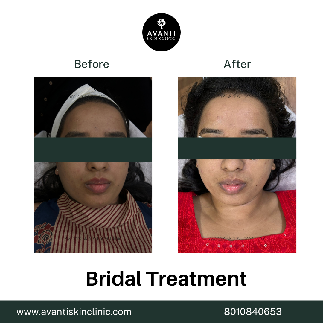 Acne Treatment (4)