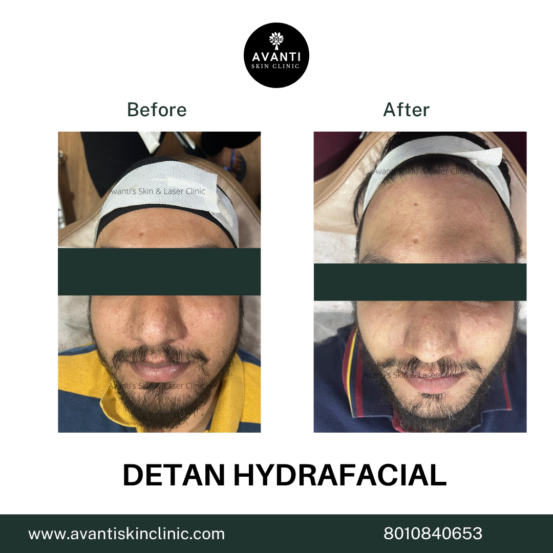 Acne Treatment (44)