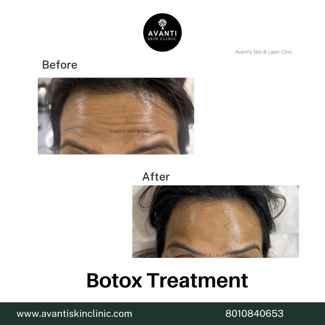 Acne Treatment (5)