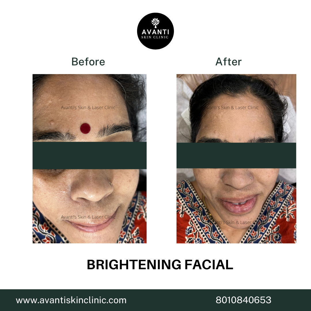 Acne Treatment (50)