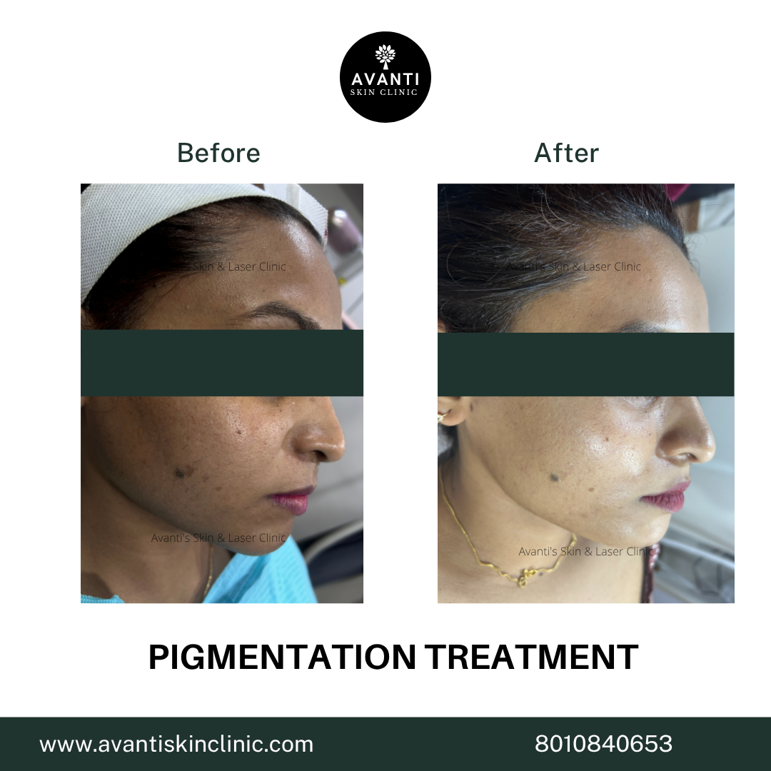 Acne Treatment (51)