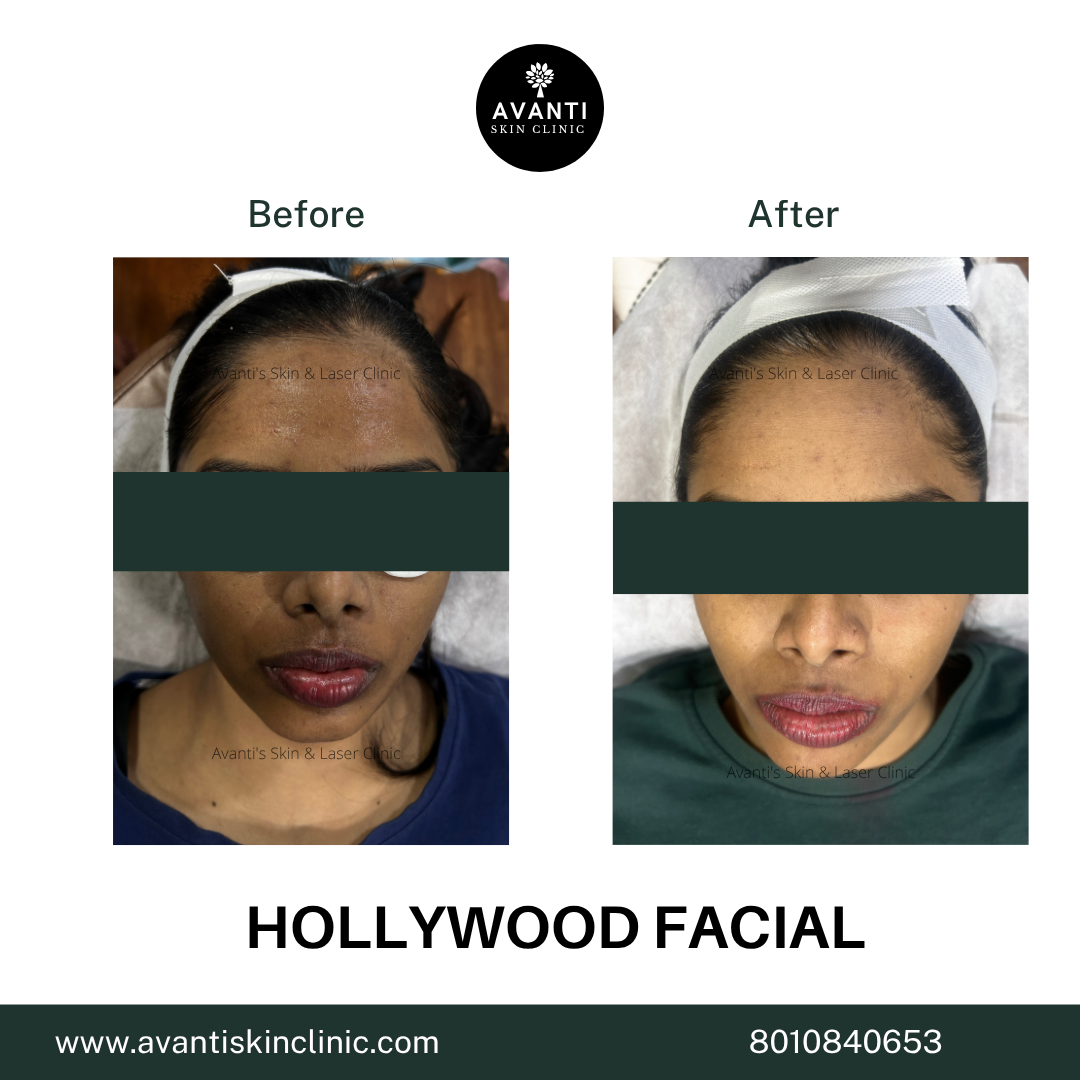 Acne Treatment (54)
