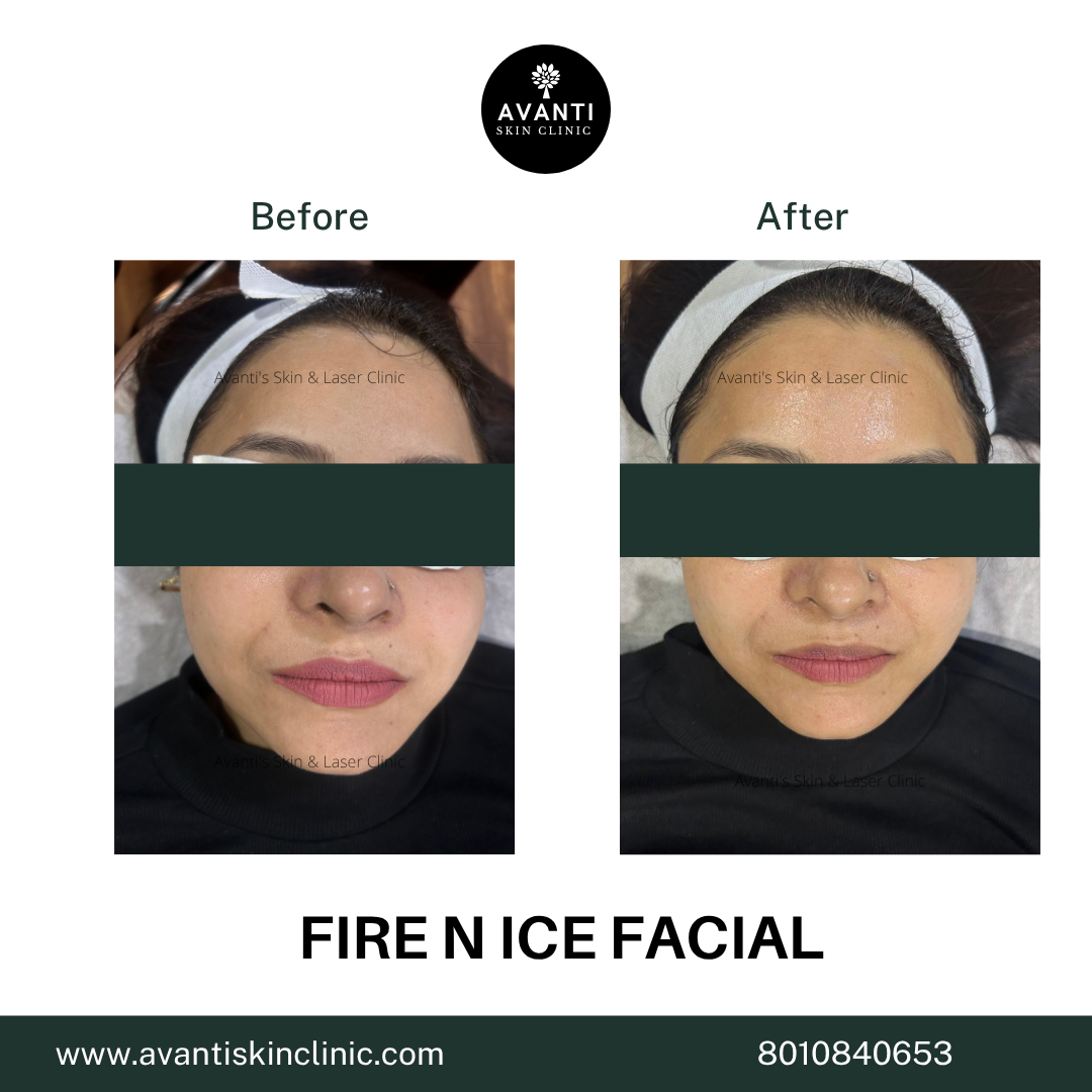 Acne Treatment (56)