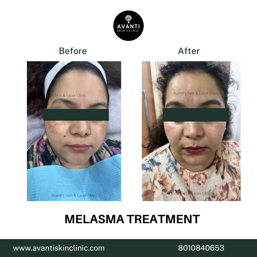 Acne Treatment (72)
