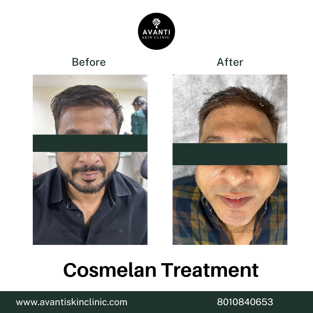 Acne Treatment (9)