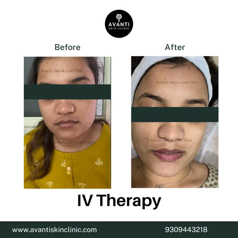 iv drip glutathione before and after Glutathione IV Drip in Pune Cost Starting at ₹5,000