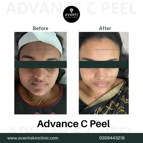 before and after glutathione benefits Glutathione IV Therapy Benefits – How It Helps Skin & Health