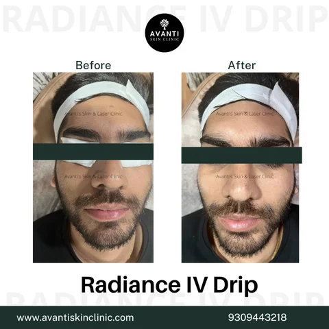 Glutathione IV Therapy Benefits – How It Helps Skin & Health
